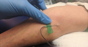 Platelet Rich Plasma PRP singapore