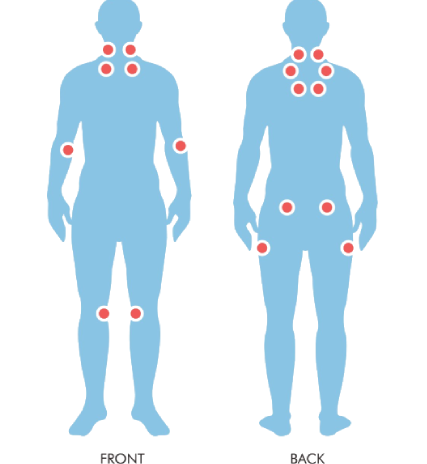 Fibromyalgia Fibromyalgia