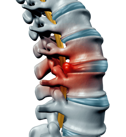 Slipped Disc bone Slipped Disc bone