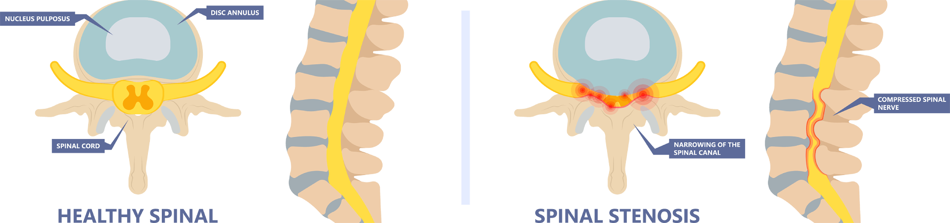 Spinal Stenosis