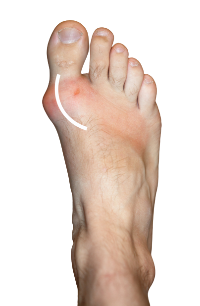 Foot Pain-Gout
