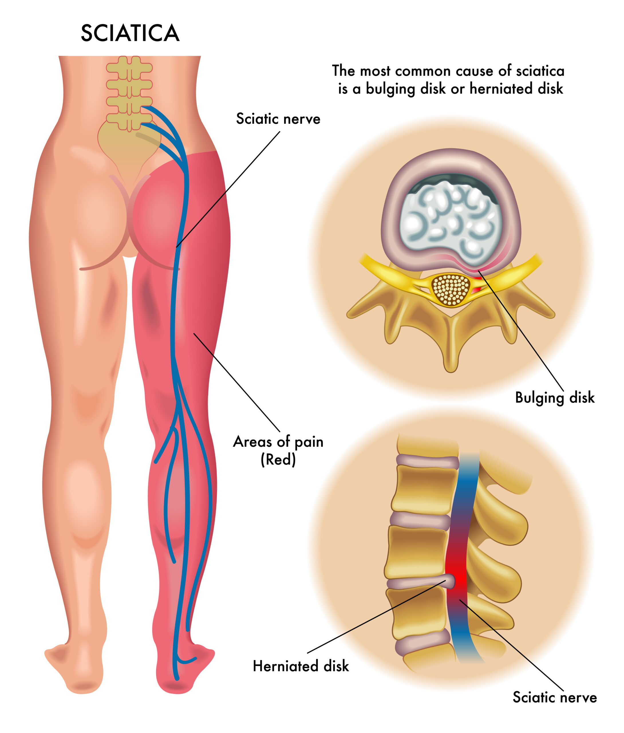 Proper sitting posture-end low back pain! 